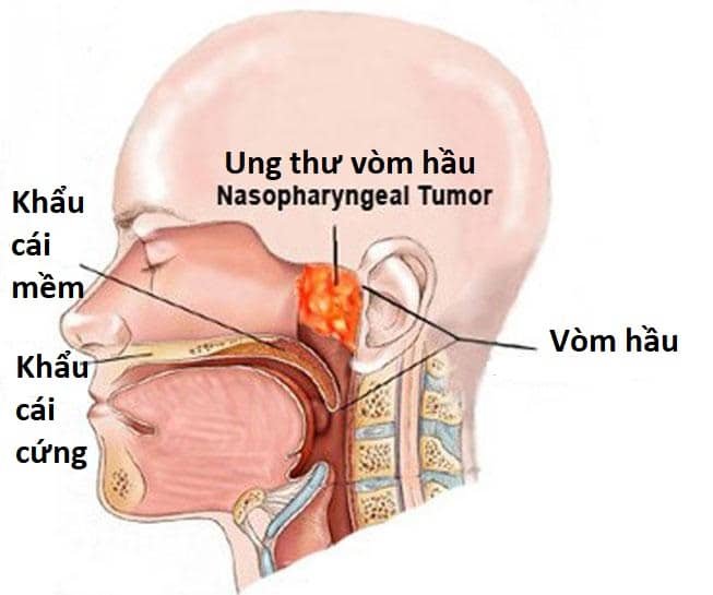 Hình ảnh giải phẫu bệnh ung thư hầu họng.