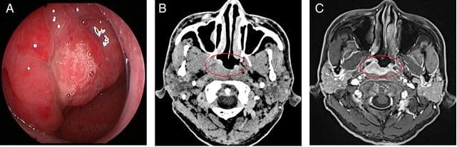 Hình: ung thư vòm họng được quan sát trên cùng một bệnh nhân: A. Nội soi tai mũi họng, B. Chụp cắt lớp vi tính (CT) đầu và cổ, C. Chụp cộng hưởng từ (MRI) đầu và cổ.
